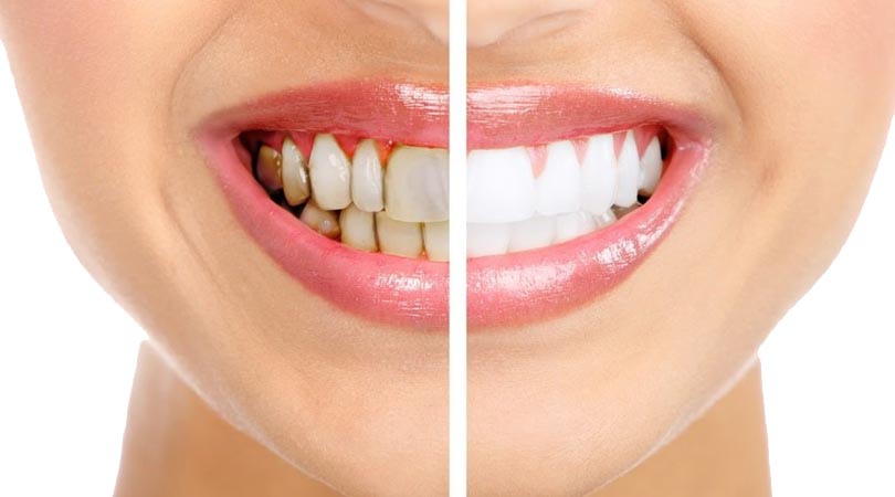 Diş Beyazlatma (Bleaching) Nedir?