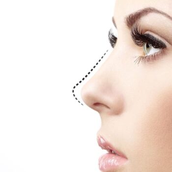 Rhinoplastie De Révision